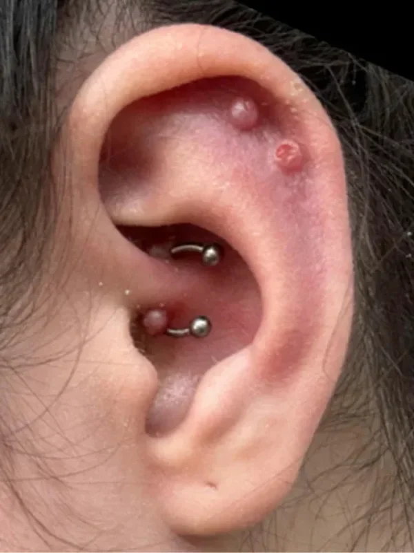 hipergranulación en perforaciones o piercing de la oreja